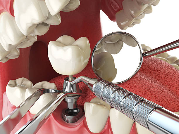 Tooth Infection Emergency Dentist in VA